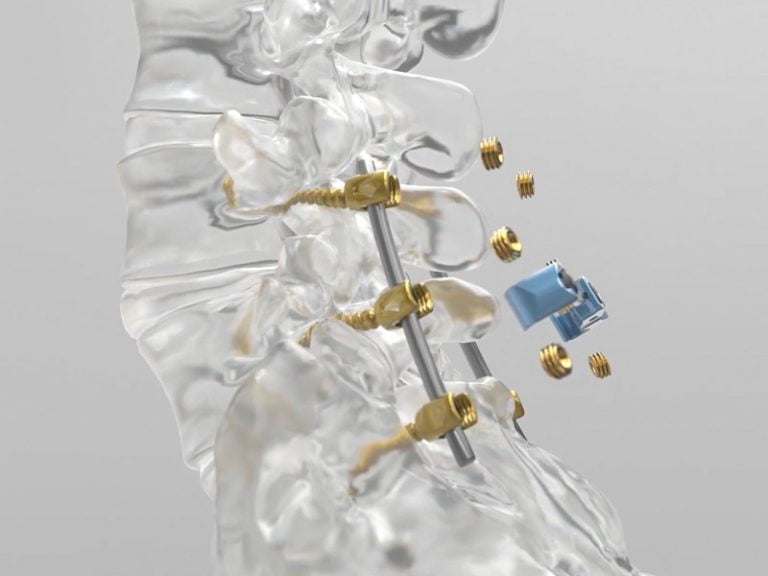 Spinal Elements – IPO Video