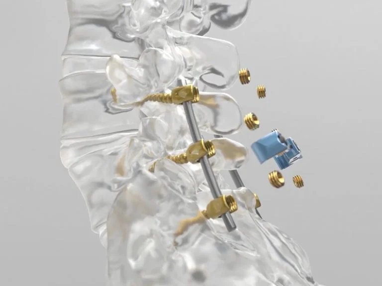 Spinal Elements – IPO Video